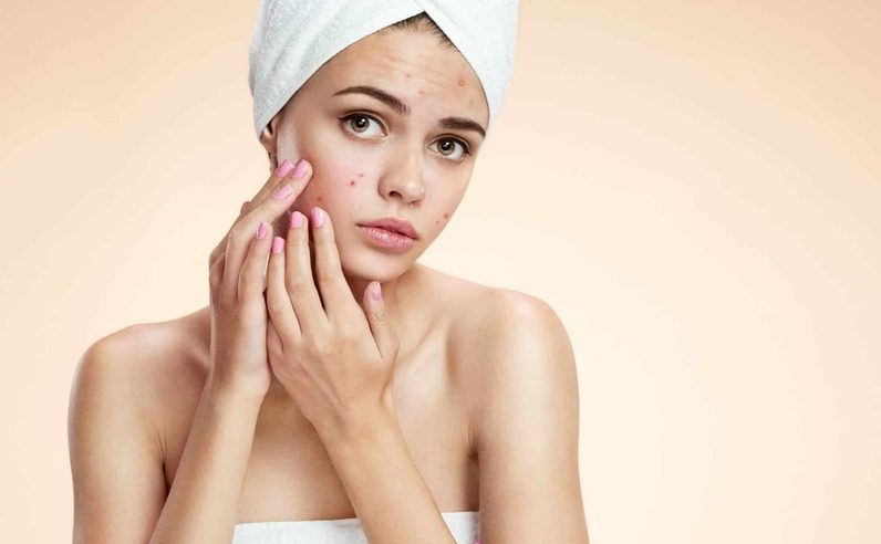 Thói quen gây mụn từ chạm tay lên mặt